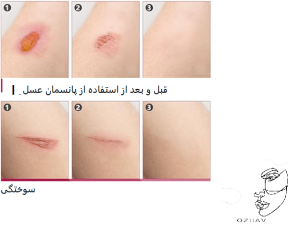 مزایای پانسمان عسل