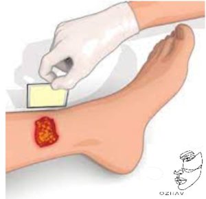 تعویض پانسمان نقره