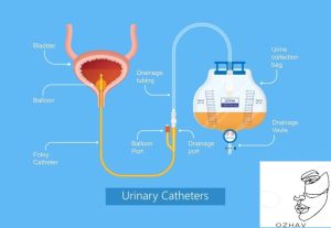 foely-catheter-use