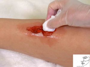 تمیزکردن زخم