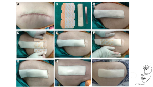 پانسمان زخم بخیه شده