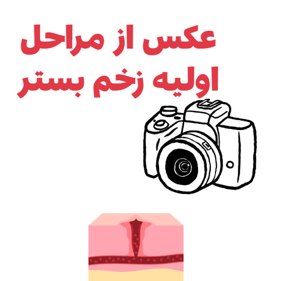 عکس از مراحل اولیه زخم بستر .7