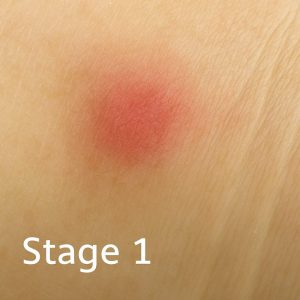 مرحله اول زخم بستر 