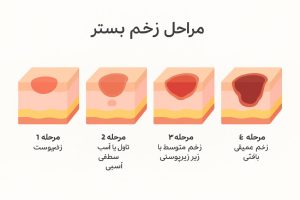 مراحل تشکیل زخم بستر 