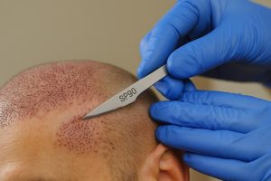 تیغ SP90 در کاشت مو