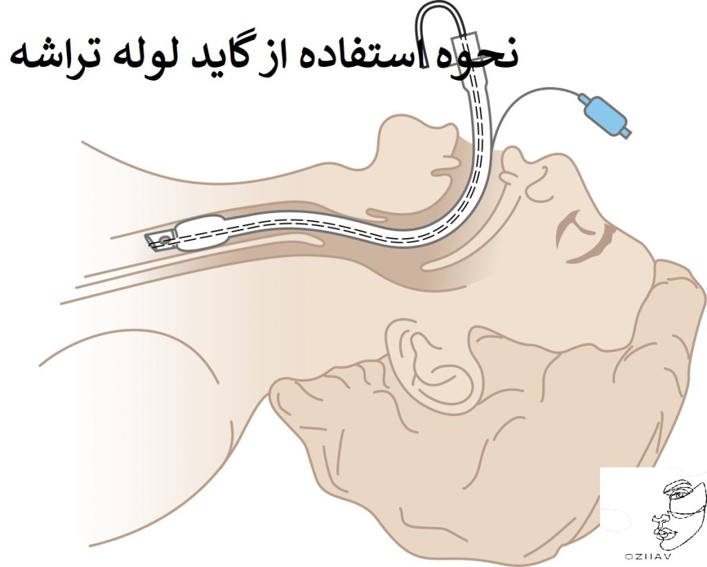 نحوه استفاده از گاید لوله تراشه