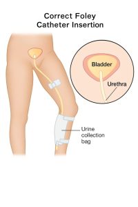 نحوه صحیح کارگذاری سوند فولی