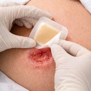 تعویض زخم بستر 