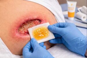 تاثیر پانسمان عسل برای زخم 