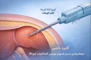 نمونه گیری با سوزن بیوپسی 18