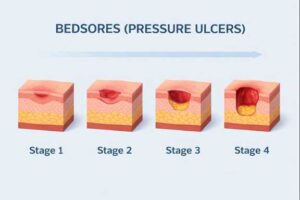 مراحل زخم بستر 