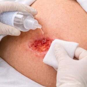 شست و شوی زخم 