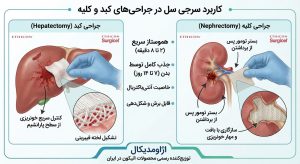 کاربرد سرجی سل در کبد و کلیه